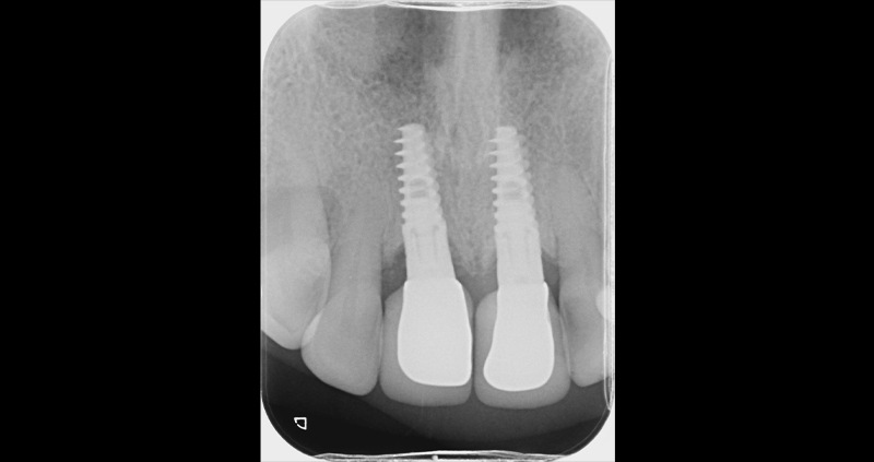 periapical 03