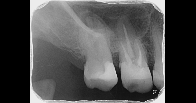 periapical 06